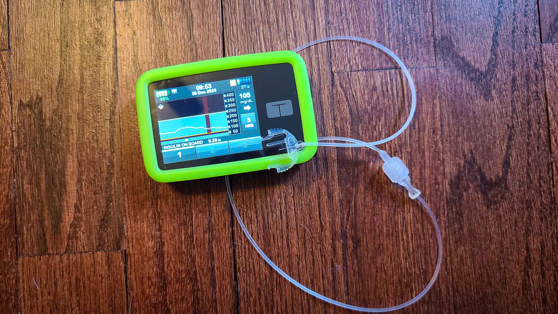 Tandem t:slim X2 insulin pump in a green case with a Trusteel infusion set attached