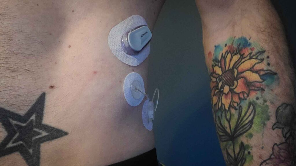 Trusteel infusion set and Dexcom G6 on an abdomen